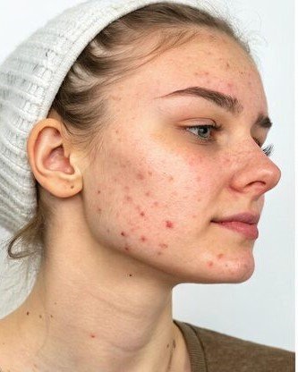 Before treatment